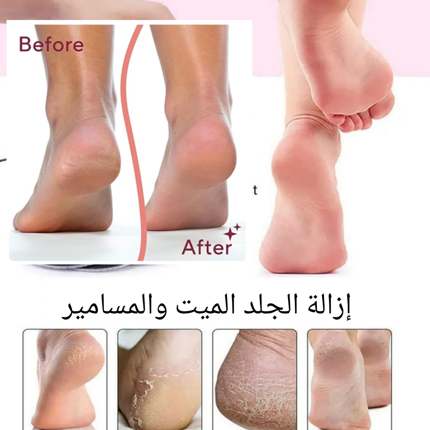أجهزة إزالة مسامير القدم الكهربائية المتقدمة Advanced Electric Feet Callus Removers