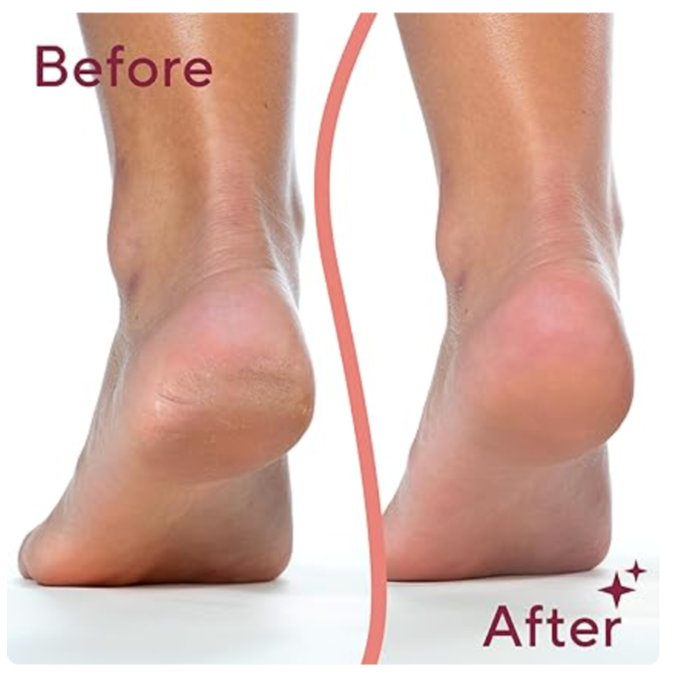 أجهزة إزالة مسامير القدم الكهربائية المتقدمة Advanced Electric Feet Callus Removers
